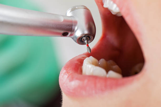 Best Emergency Dentist for Lost Fillings or Crowns in Ojai, CA